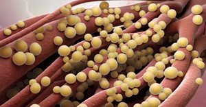 SEPSIS – die unterschätzte Krankheit